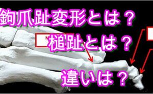 脳卒中後の鉤爪趾変形 Claw Toe とは 槌趾 マレット趾とは違うの もう一つの理学への道